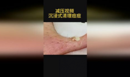 粉刺视频,视频教你轻松应对